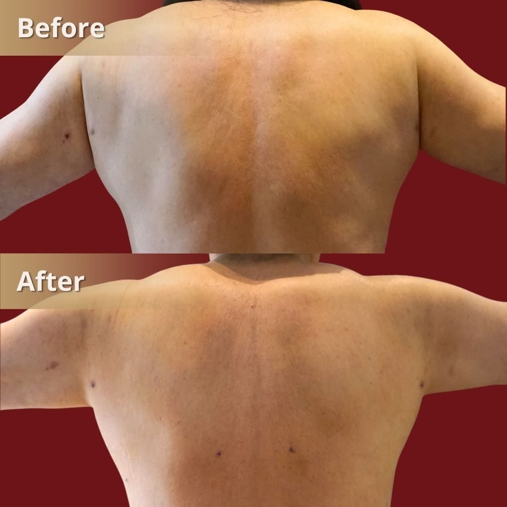 Foto sebelum dan sesudah Liposuction (Sedot Lemak) pada pasien The Mercy Clinic